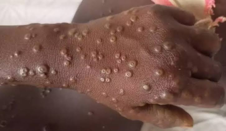 Western Region records 71% of Ghana’s Mpox cases, Health alert issued
